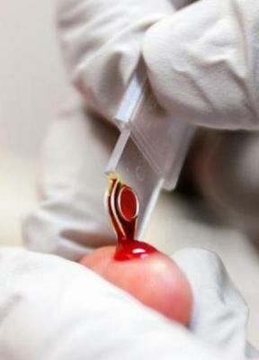 Чему равна норма СОЭ в анализе крови?