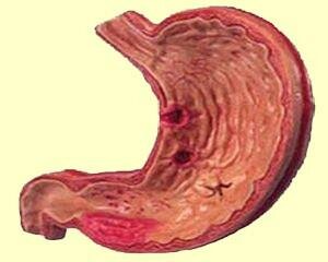 Осложнения язвенной болезни желудка и 12-перстной кишки опасны для жизни