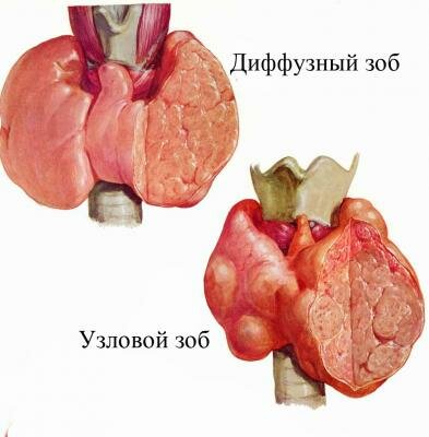 Заболевания щитовидной железы или узловой зоб 1 степени