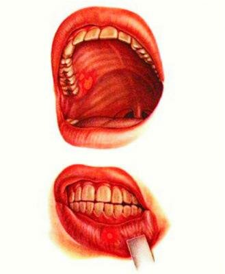 Воспаление слизистой рта: из-за других недугов и горячей еды 